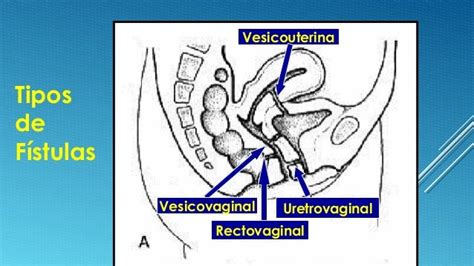 Esquema de una fístula vesicovaginal y rectovaginal