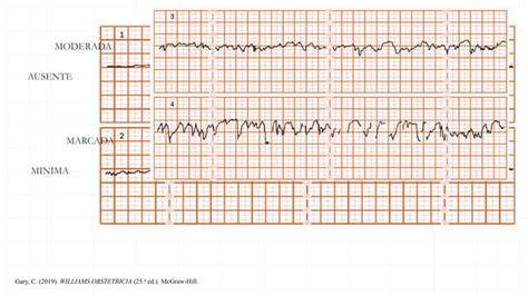 Ejemplo de trazado de cardiotocografía con patrón de variabilidad saltatoria (zigzag)