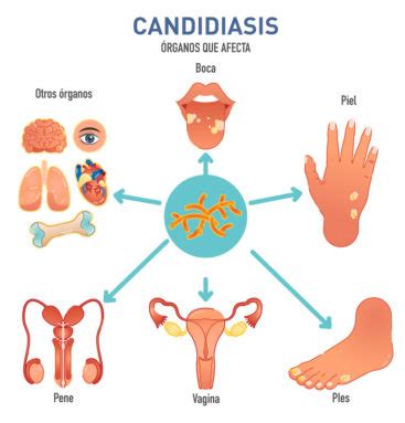 Esquema de la anatomía vaginal y la ubicación de la infección por candidiasis