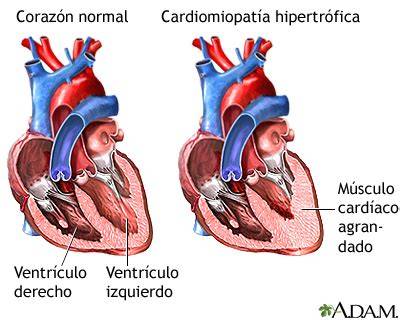 Diagrama de un corazón con miocardiopatía hipertrófica mostrando el engrosamiento del ventrículo izquierdo.