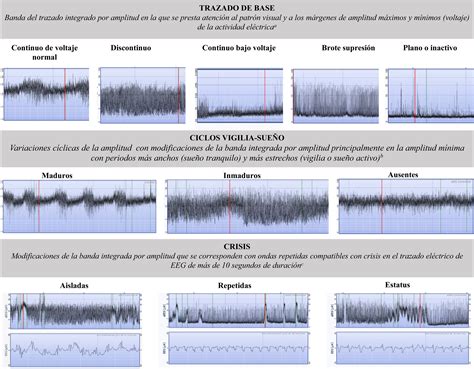 Ejemplos de patrones de EEG integrado por amplitud en EHI