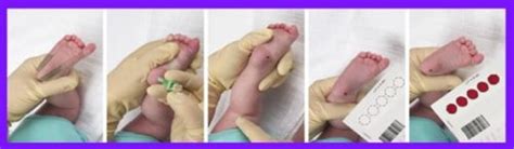 Esquema detallado de la punción del talón en un recién nacido para la recolección de muestra de sangre en papel de filtro, mostrando la correcta aplicación de la gota en el círculo del papel.