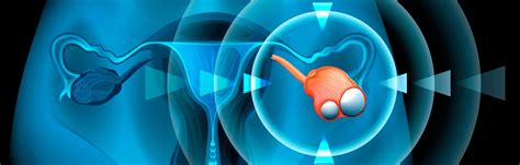 Ilustración médica de los ovarios con quistes