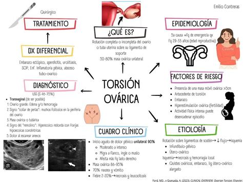 Ilustración médica de la torsión ovárica