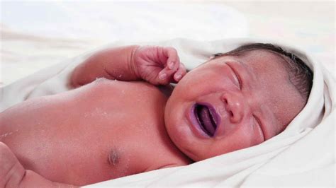 Foto de un recién nacido con cianosis o dificultad respiratoria