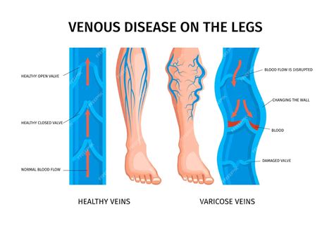 infografía sobre la anatomía venosa y el flujo sanguíneo en las piernas