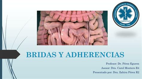 Esquema de las adherencias internas tras una cesárea, mostrando cómo afectan a los órganos