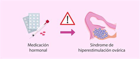 Ilustración esquemática del síndrome de hiperestimulación ovárica