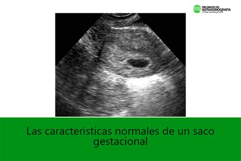 Imagen ecográfica de un saco gestacional vacío