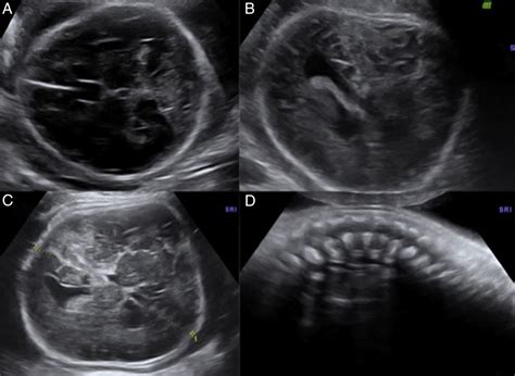 Infografía: hallazgos de displasia megalencefálica en ecografía fetal