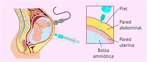 Esquema del procedimiento de amniocentesis