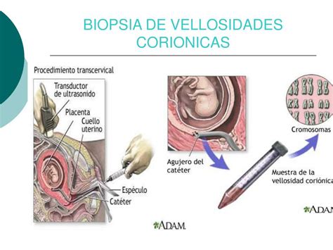 Esquema del procedimiento de biopsia de vellosidades coriónicas