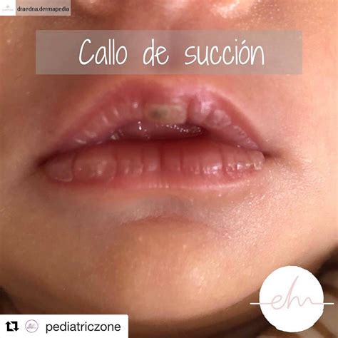 Representación gráfica del callo de succión en el labio superior de un bebé.