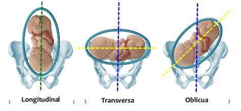 Representación de un feto en situación transversa y oblicua