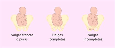 Ilustración de los diferentes tipos de presentación podálica: franca, completa y de pie