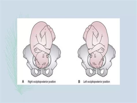 Representación de la posición occipital posterior