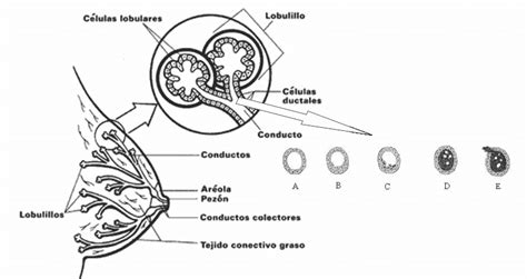Ilustración de un conducto mamario bloqueado y la formación de un galactocele