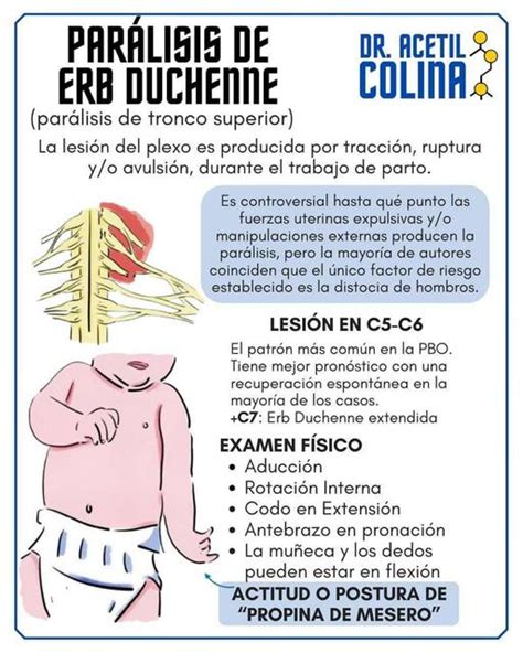 Foto de un brazo de bebé con parálisis de Erb-Duchenne mostrando la postura típica de 