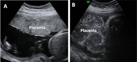 Ecografía de una placenta con calcificaciones