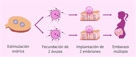 Gráfico de reducción de tasa de embarazo múltiple en clínicas de reproducción asistida