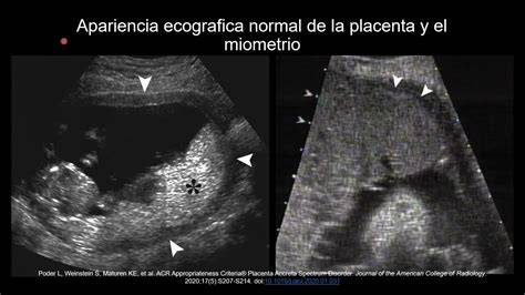 Ecografía que muestra signos sugestivos de placenta accreta