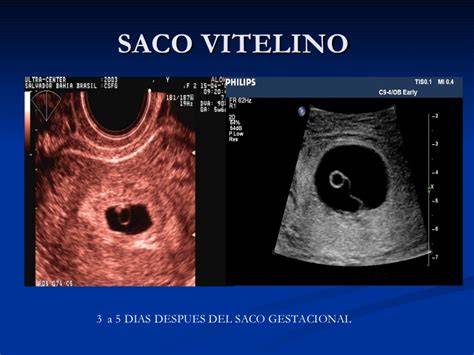 Imagen de ecografía temprana mostrando el saco gestacional y el saco vitelino