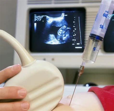 Imagen de una aguja de amniocentesis siendo guiada por ultrasonido en el abdomen materno