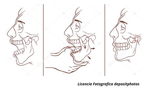 Diagrama de la elevación o subluxación mandibular en un lactante.