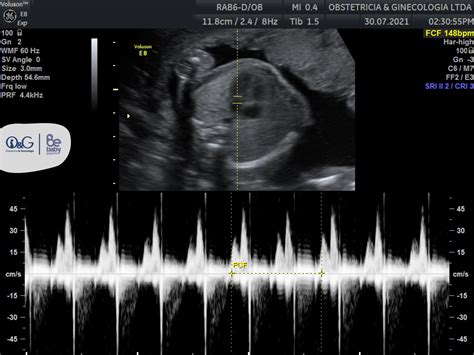 Imagen de ecografía mostrando hidropesía fetal (acumulación de líquido)