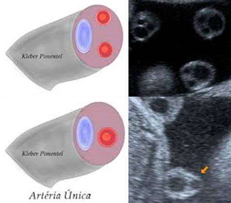 Ecografía mostrando una arteria umbilical única