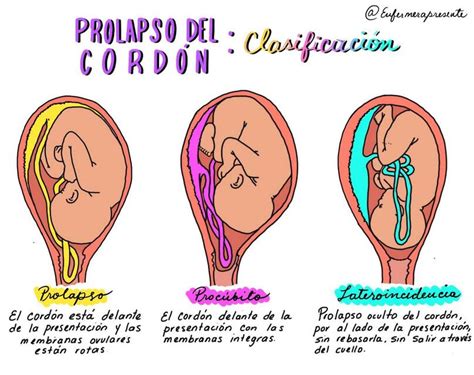 Ilustración de un prolapso de cordón umbilical