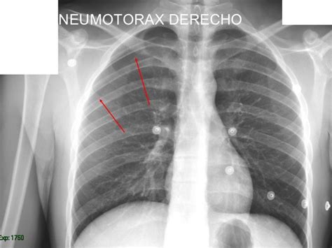 Radiografía de tórax de un neonato con neumotórax, mostrando hiperclaridad y desplazamiento mediastínico
