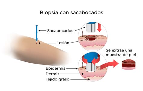 Ilustración: Proceso de biopsia testicular