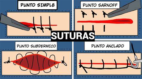 Esquema de tipos de puntos de sutura en una herida