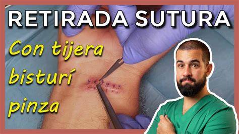 Proceso de retirada de puntos de sutura por un profesional