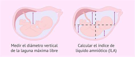Diagrama comparativo de los métodos ILA y MCV/BVUP para la medición del líquido amniótico