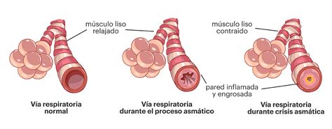 Esquema de vías respiratorias inflamadas durante una crisis de asma