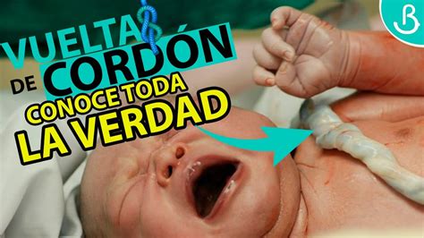 Representación de un bebé con vueltas de cordón, mostrando la mayoría como inofensivas