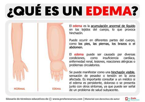 Esquema de las áreas del cuerpo más afectadas por el edema, especialmente piernas y tobillos.