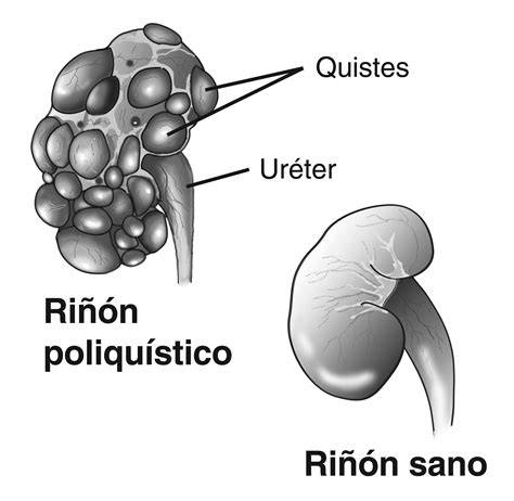Imagen de riñón poliquístico vs. riñón sano