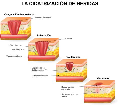 Infografía: Fases de la cicatrización de una herida explicando cada etapa