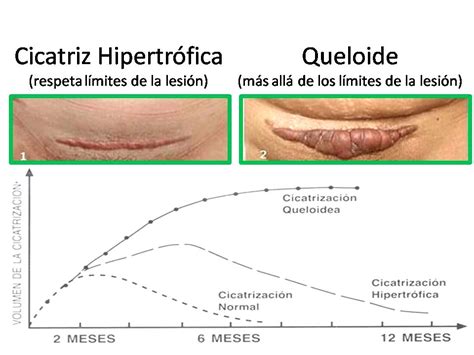 Comparación visual de cicatriz lineal, hipertrófica y queloide de cesárea