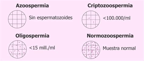 Gráfico ilustrativo de los resultados posibles de un espermiograma post-vasectomía (azoospermia, oligozoospermia, presencia de espermatozoides móviles)