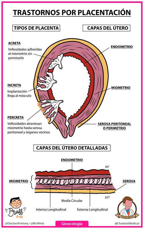 Esquema de la clasificación del acretismo placentario (acreta, increta, percreta)