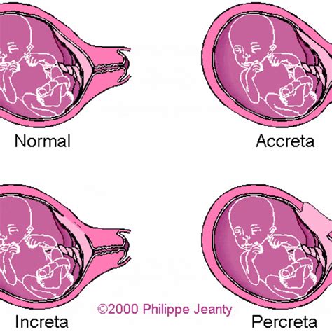 Representación esquemática de la invasión de la placenta percreta en la vejiga