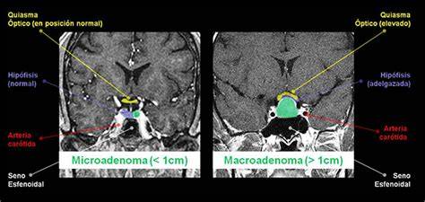 Imagen de resonancia magnética cerebral mostrando un microadenoma hipofisario