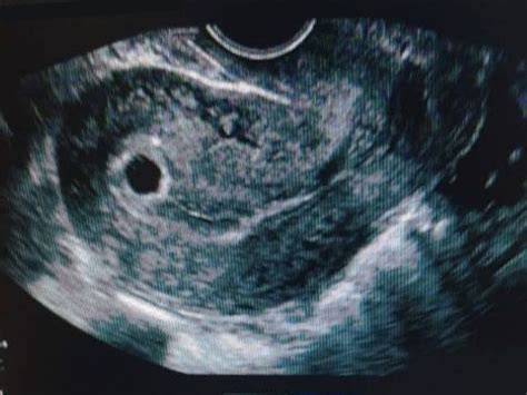 Ecografía fetal del primer trimestre