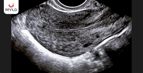 Imagen de ecografía mostrando un endometrio trilaminar óptimo
