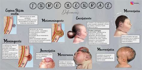 Esquema de las principales malformaciones por defectos del tubo neural (anencefalia, espina bífida)