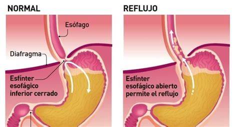 Esquema del sistema digestivo de un bebé mostrando el esfínter esofágico inferior inmaduro